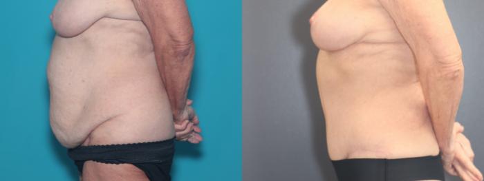 Before & After Tummy Tuck Case 526 Left Side View in West Des Moines & Ames, IA