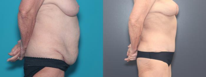 Before & After Tummy Tuck Case 526 Right Side View in West Des Moines & Ames, IA