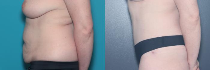 Before & After Tummy Tuck Case 531 Left Side View in West Des Moines & Ames, IA