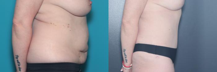 Before & After Tummy Tuck Case 531 Right Side View in West Des Moines & Ames, IA