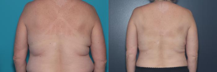Before & After Tummy Tuck Case 536 Back View in West Des Moines & Ames, IA