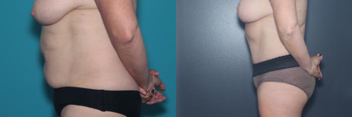 Before & After Tummy Tuck Case 536 Left Side View in West Des Moines & Ames, IA
