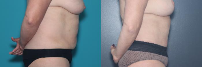 Before & After Tummy Tuck Case 536 Right Side View in West Des Moines & Ames, IA