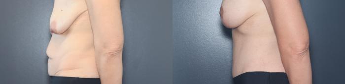 Before & After Tummy Tuck Case 541 Left Side View in West Des Moines & Ames, IA