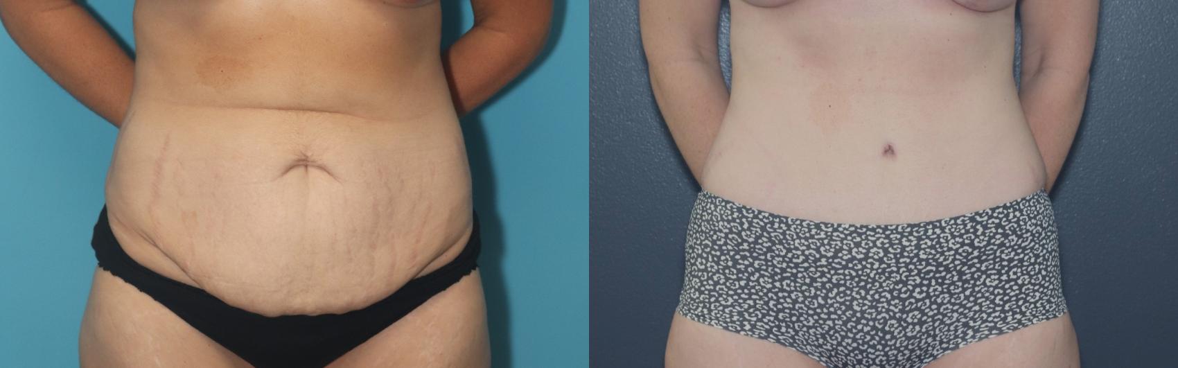 Before & After Liposuction/ Fat Transfer/ Brazilian Butt Lift Case 544 Front View in West Des Moines & Ames, IA