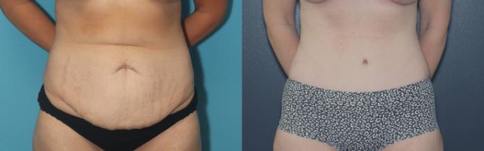 Before & After Liposuction/ Fat Transfer/ Brazilian Butt Lift Case 544 Front View in West Des Moines & Ames, IA
