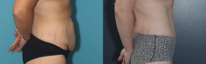 Before & After Liposuction/ Fat Transfer/ Brazilian Butt Lift Case 544 Right Side View in West Des Moines & Ames, IA