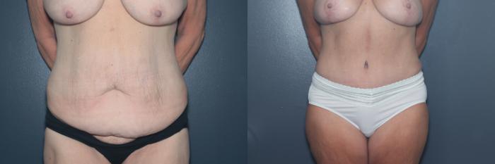 Before & After Liposuction/ Fat Transfer/ Brazilian Butt Lift Case 570 Front View in West Des Moines & Ames, IA