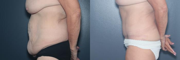 Before & After Liposuction/ Fat Transfer/ Brazilian Butt Lift Case 570 Left Side View in West Des Moines & Ames, IA