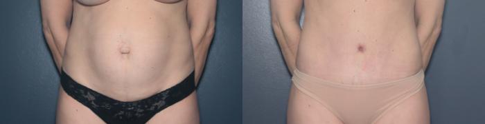 Before & After Tummy Tuck Case 573 Front View in West Des Moines & Ames, IA