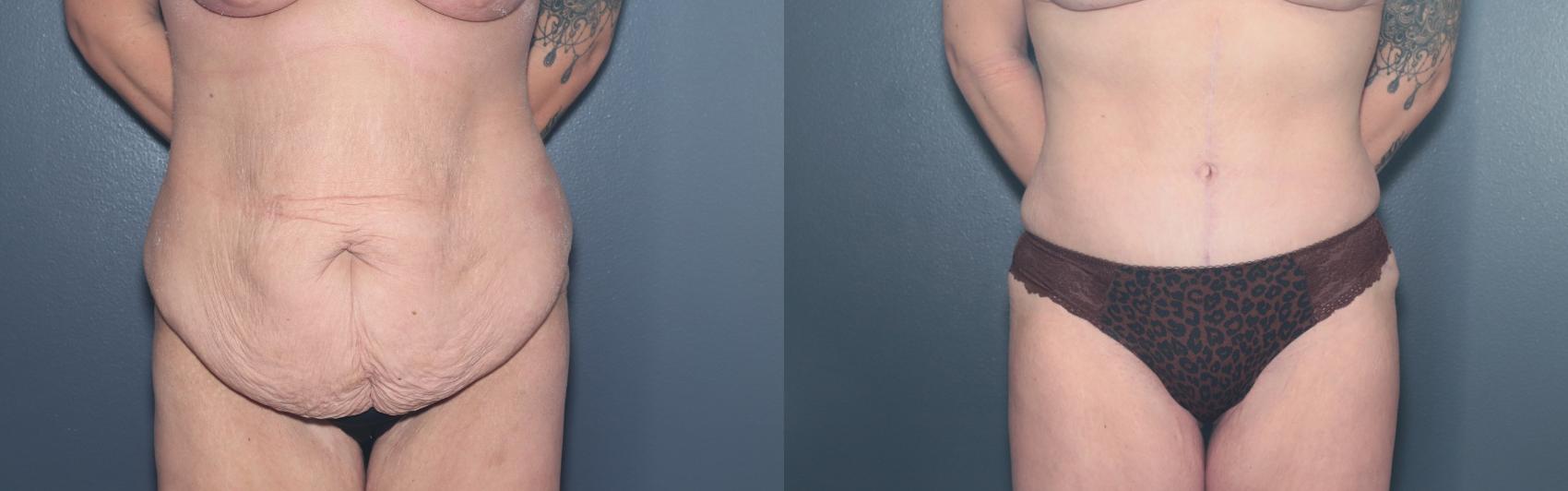 Before & After Tummy Tuck Case 596 Front View in West Des Moines & Ames, IA