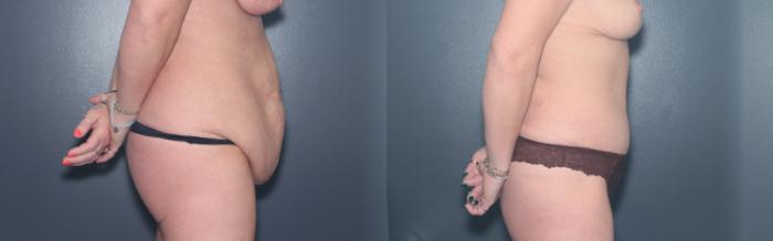 Before & After Tummy Tuck Case 596 Left Side View in West Des Moines & Ames, IA