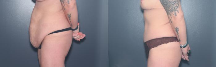 Before & After Tummy Tuck Case 596 Right Side View in West Des Moines & Ames, IA