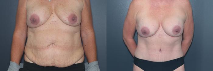 Before & After Tummy Tuck Case 600 Front View in West Des Moines & Ames, IA
