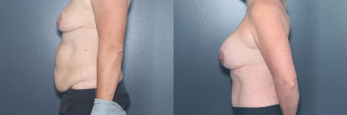 Before & After Tummy Tuck Case 600 Right Side View in West Des Moines & Ames, IA