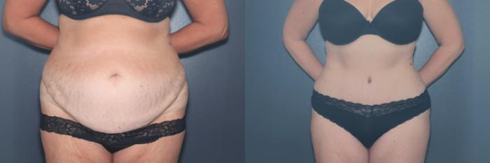 Before & After Tummy Tuck Case 613 Front View in West Des Moines & Ames, IA