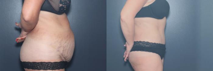 Before & After Tummy Tuck Case 613 Left Side View in West Des Moines & Ames, IA