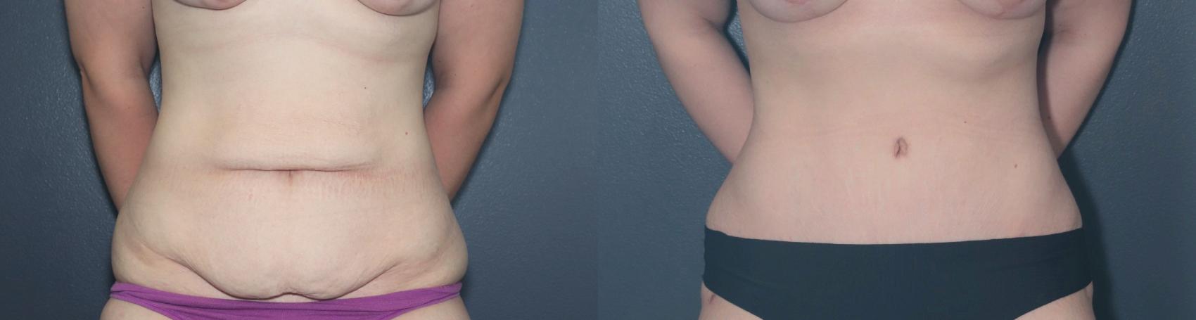 Before & After Tummy Tuck Case 617 Front View in West Des Moines & Ames, IA