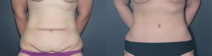 Before & After Tummy Tuck Case 617 Front View in West Des Moines & Ames, IA