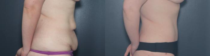 Before & After Tummy Tuck Case 617 Left Side View in West Des Moines & Ames, IA