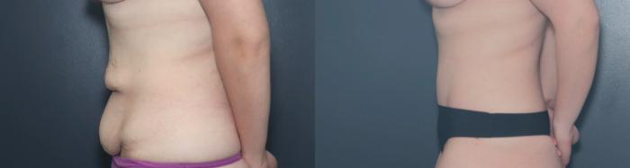 Before & After Tummy Tuck Case 617 Right Side View in West Des Moines & Ames, IA