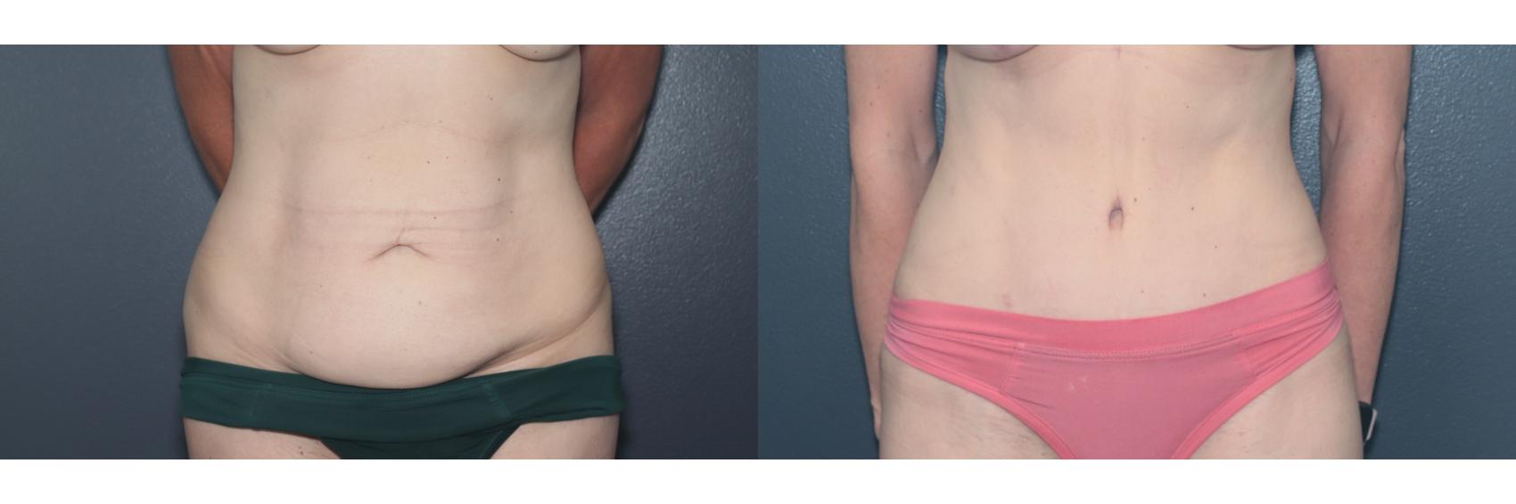 Before & After Tummy Tuck Case 622 Front View in West Des Moines & Ames, IA
