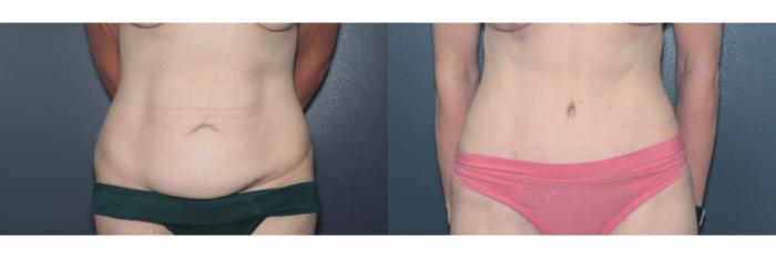 Before & After Tummy Tuck Case 622 Front View in West Des Moines & Ames, IA