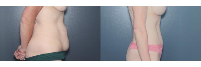Before & After Tummy Tuck Case 622 Left Side View in West Des Moines & Ames, IA