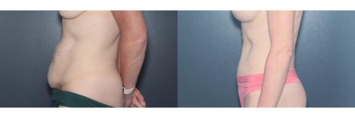 Before & After Tummy Tuck Case 622 Right Side View in West Des Moines & Ames, IA