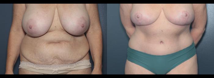 Before & After Tummy Tuck Case 625 Front View in West Des Moines & Ames, IA