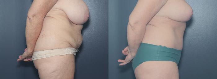 Before & After Tummy Tuck Case 625 Left Side View in West Des Moines & Ames, IA