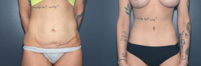 Before & After Tummy Tuck Case 633 Front View in West Des Moines & Ames, IA