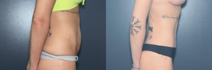 Before & After Tummy Tuck Case 633 Left Side View in West Des Moines & Ames, IA