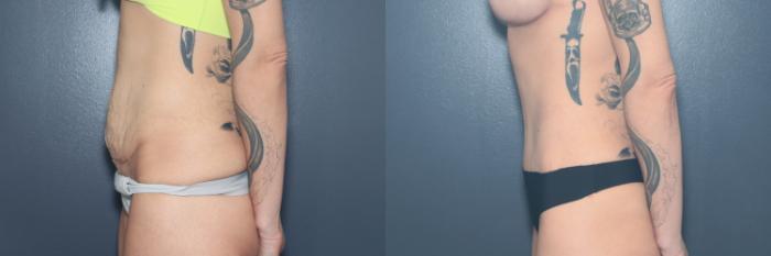 Before & After Tummy Tuck Case 633 Right Side View in West Des Moines & Ames, IA