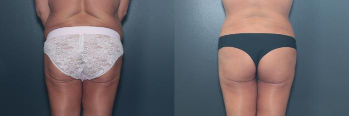 Before & After Tummy Tuck Case 642 Back View in West Des Moines & Ames, IA