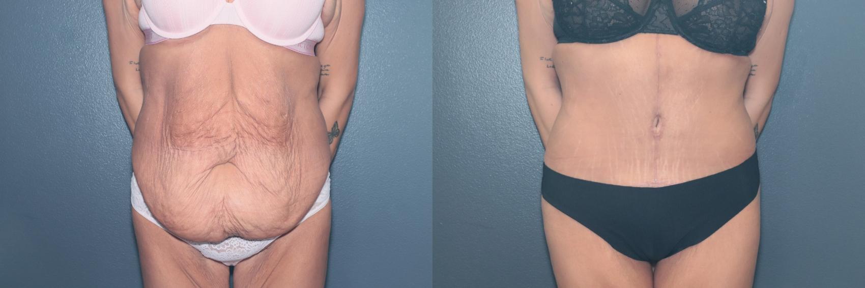 Before & After Tummy Tuck Case 642 Front View in West Des Moines & Ames, IA