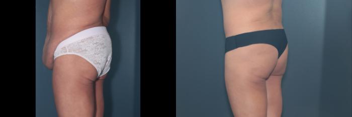 Before & After Tummy Tuck Case 642 Right Oblique View in West Des Moines & Ames, IA
