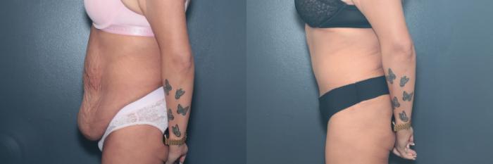 Before & After Tummy Tuck Case 642 Right Side View in West Des Moines & Ames, IA