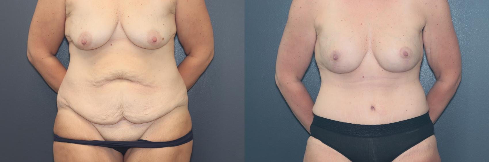 Before & After Tummy Tuck Case 644 Front View in West Des Moines & Ames, IA