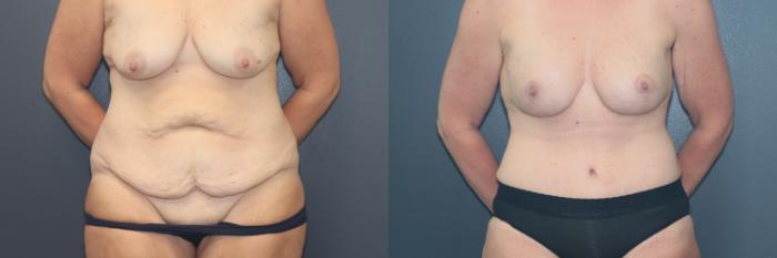 Before & After Tummy Tuck Case 644 Front View in West Des Moines & Ames, IA