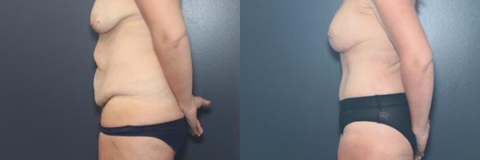 Before & After Tummy Tuck Case 644 Left Side View in West Des Moines & Ames, IA