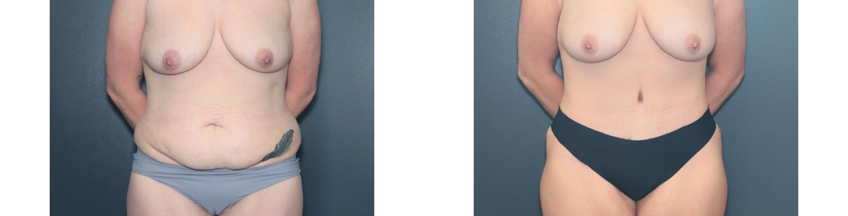 Before & After Tummy Tuck Case 648 Front View in West Des Moines & Ames, IA