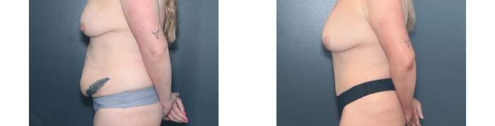 Before & After Tummy Tuck Case 648 Left Side View in West Des Moines & Ames, IA