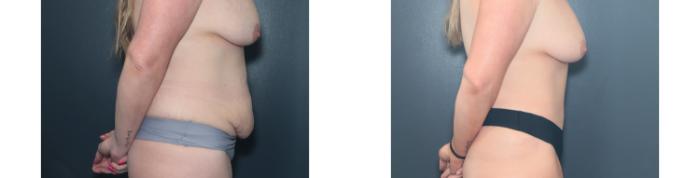 Before & After Tummy Tuck Case 648 Right Side View in West Des Moines & Ames, IA