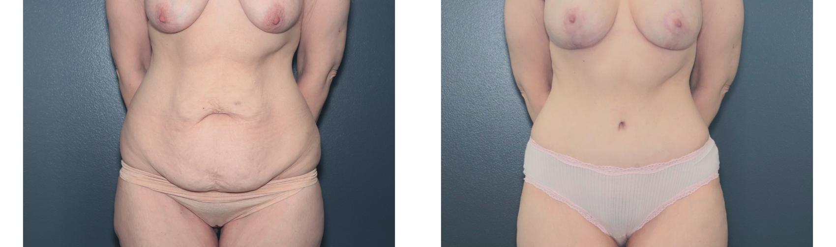 Before & After Tummy Tuck Case 652 Front View in West Des Moines & Ames, IA