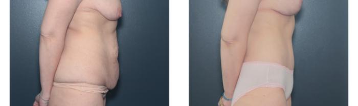 Before & After Tummy Tuck Case 652 Left Side View in West Des Moines & Ames, IA