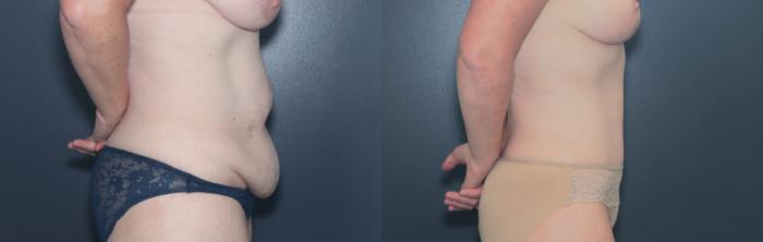 Before & After Tummy Tuck Case 653 Left Side View in West Des Moines & Ames, IA