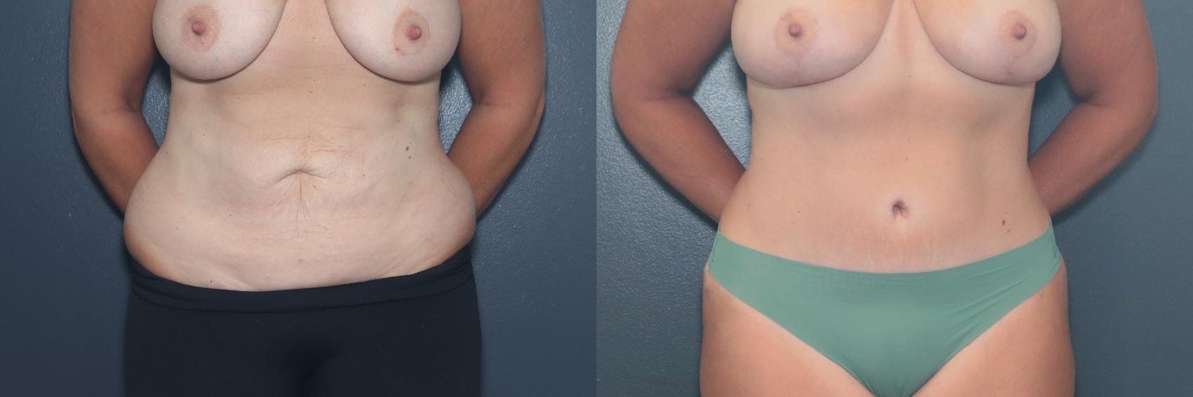 Before & After Tummy Tuck Case 655 Front View in West Des Moines & Ames, IA