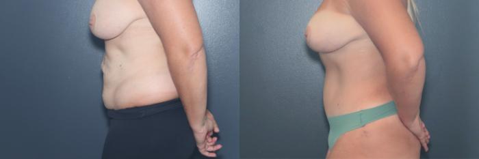 Before & After Tummy Tuck Case 655 Right Side View in West Des Moines & Ames, IA