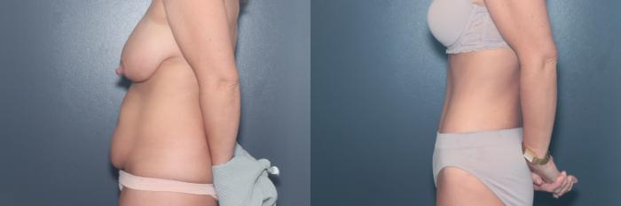 Before & After Tummy Tuck Case 663 Right Side View in West Des Moines & Ames, IA